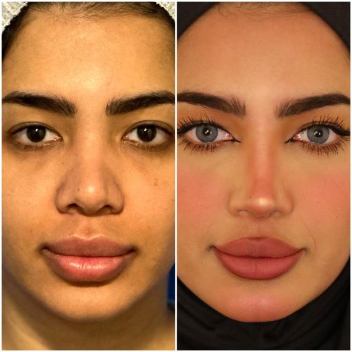 افضل دكتور تجميل انف في مصر 2026